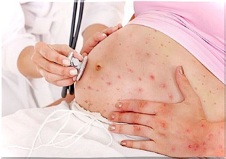 Congenital chickenpox: What are they and what are the risks?