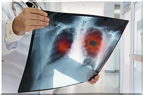 Cystic fibrosis in children: doctors examine X-ray of lungs