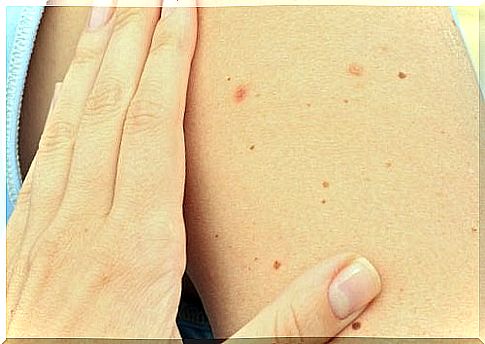 Liver spots on skin