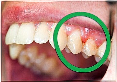 Gingivitis during pregnancy