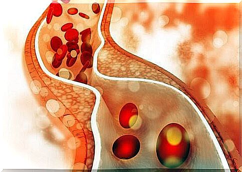 High cholesterol in children: illustration of blood vessels