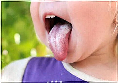 Oral candidiasis in children: symptoms, causes and treatment