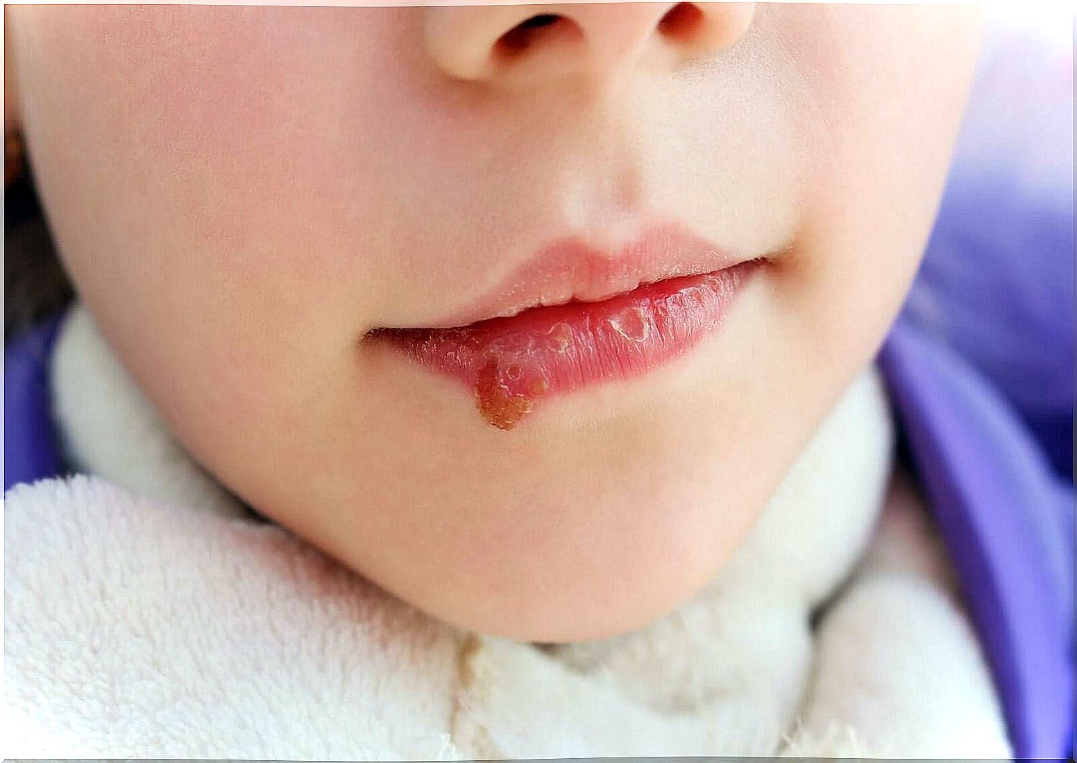 A child with a cold sore in the mouth.