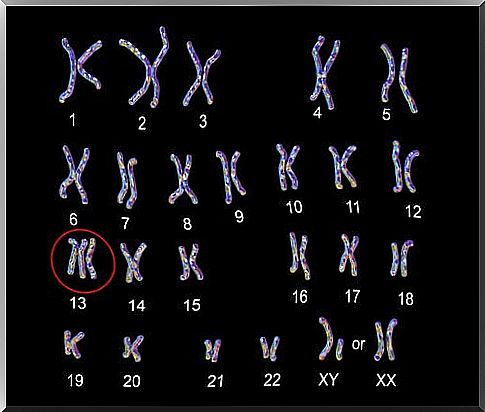 Chromosome map for Patau's syndrome