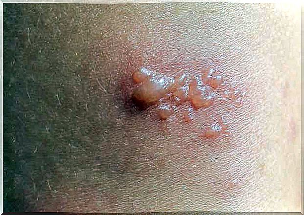 Bladder-forming autoimmune disease on a woman's skin.