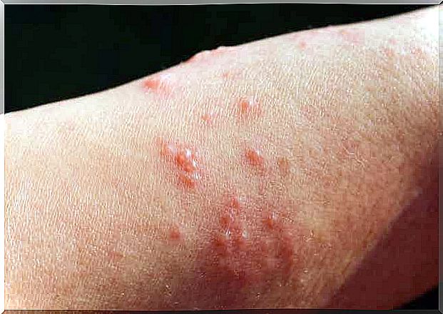 Skin rash in the form of blisters on the arm.