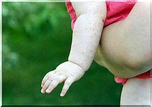 Scabies in infants: symptoms, causes and treatment