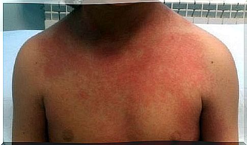 Scarlet fever in children - symptoms and treatment