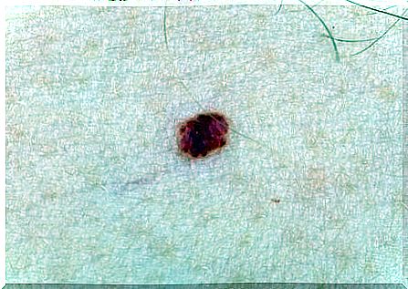 What should I do if my child has angioma?